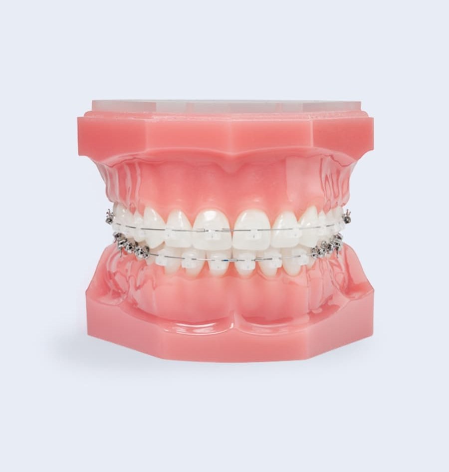 clear braces photo