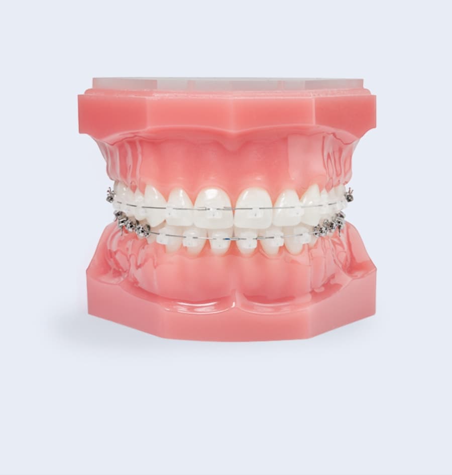 clear braces photo