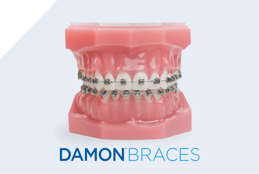 damon metal braces on plastic typodont model