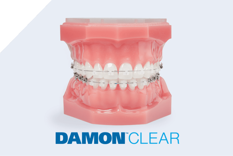 damon clear braces on plastic typodont model
