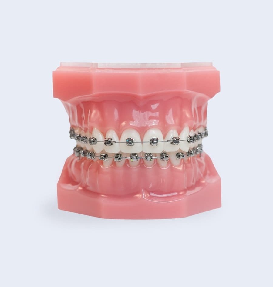 metal braces photo