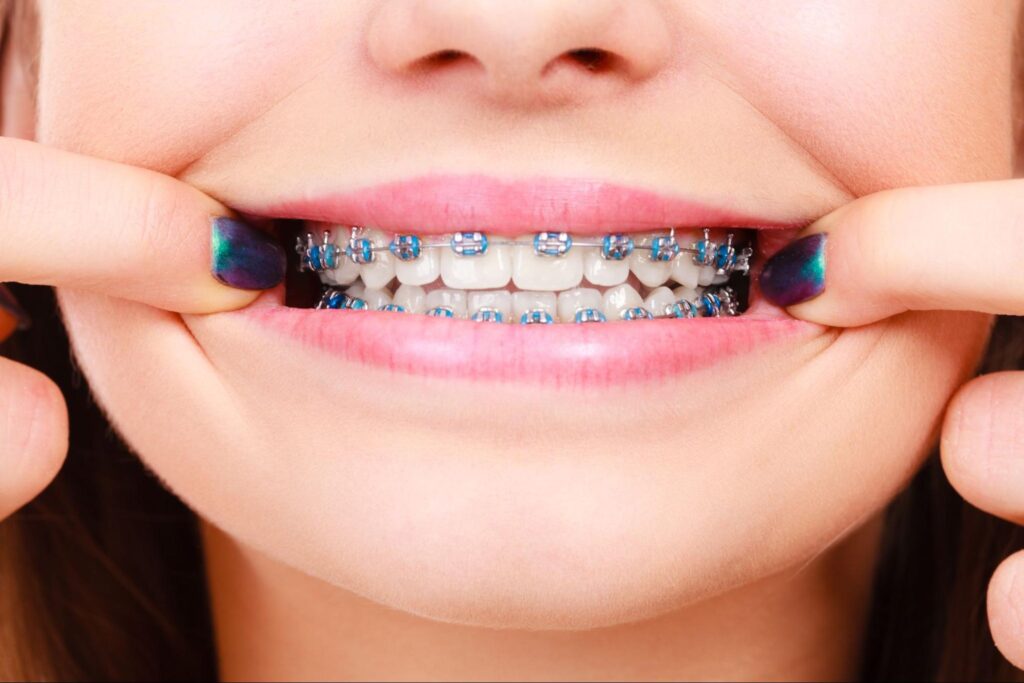 What Are the Main Elements of Braces?